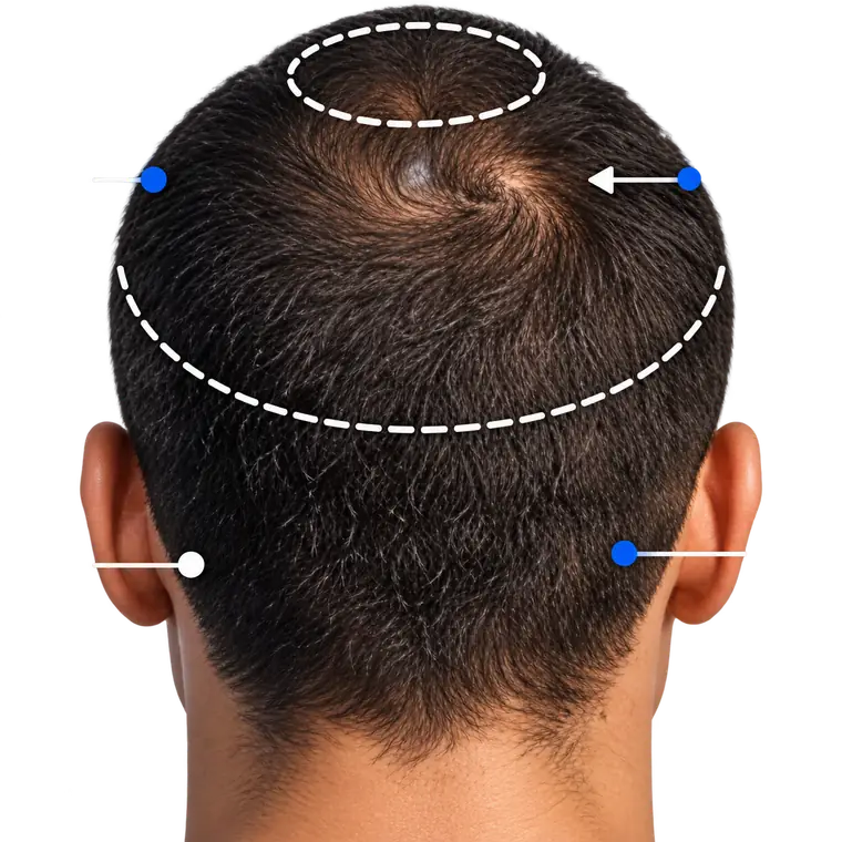 The scalp seen from behind with the treatment zones marked