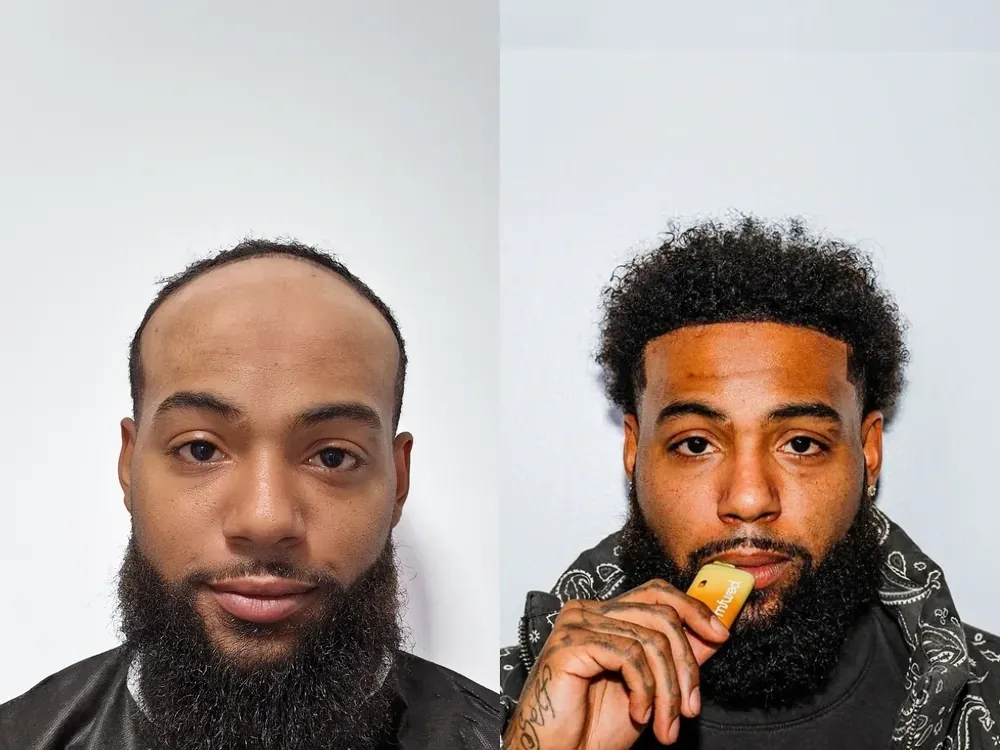 Real patient result, Afro-textured hair
