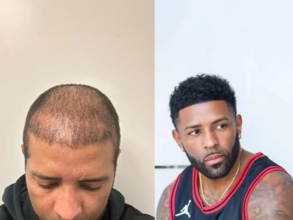 Afro-textured hair transplant, before and after