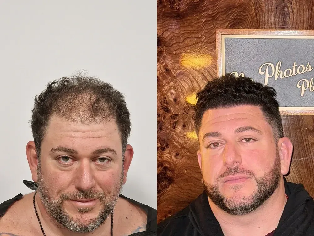Real patient result, unshaven technique