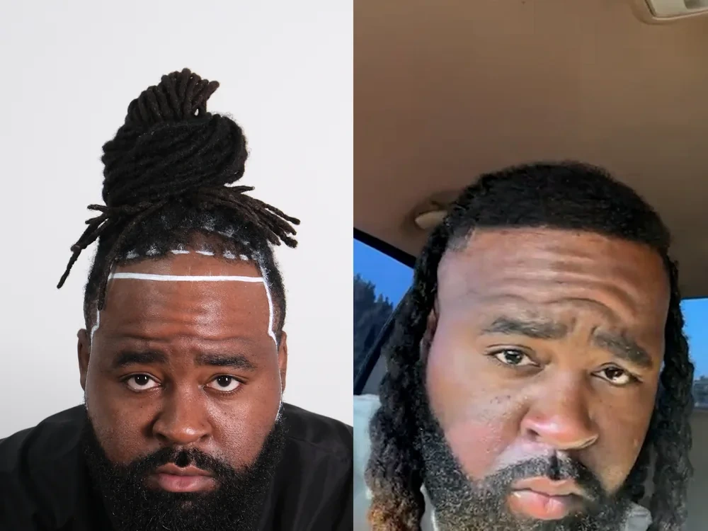 Trevor H. before and after hair transplant result