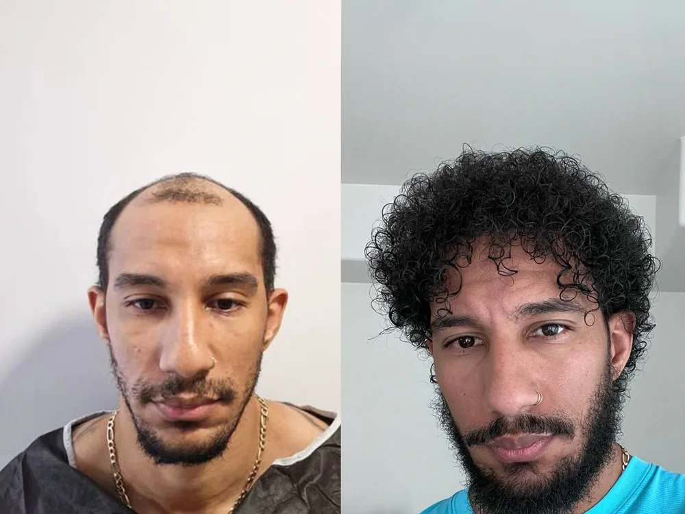 Real patient result, Sapphire FUE