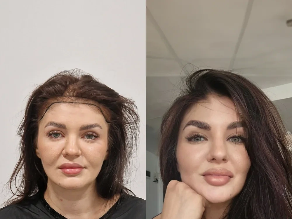 Raluca, before and after hair transplant result