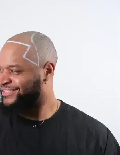 New hairline marked on a patient's scalp before the procedure