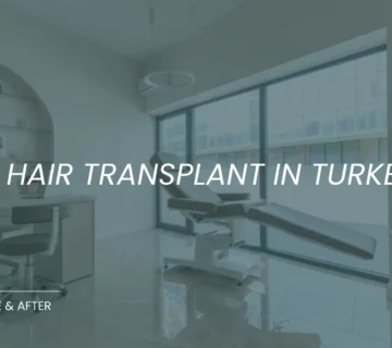 Fue Hair Transplant