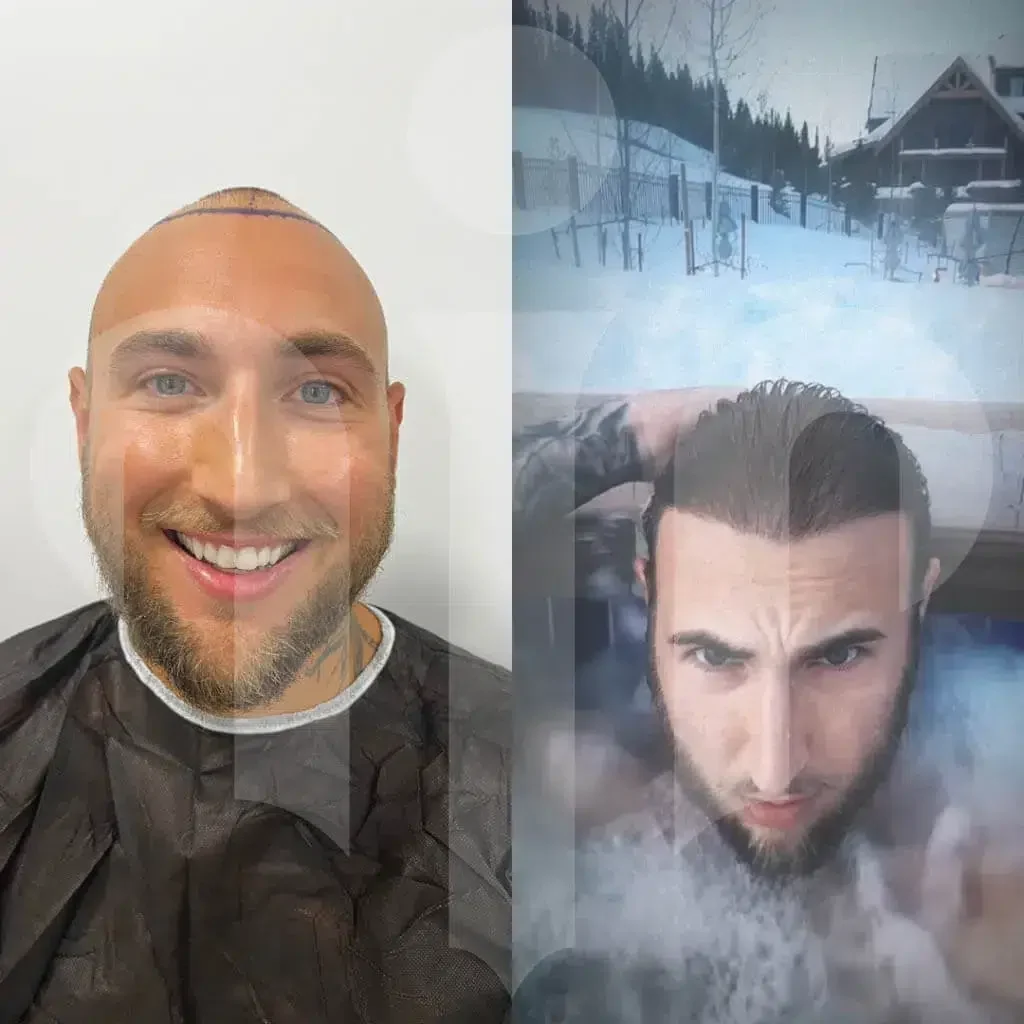 turkey hair center before after 10 1