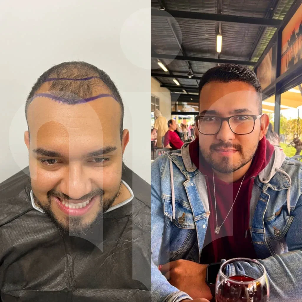 turkey hair center before after 11 1