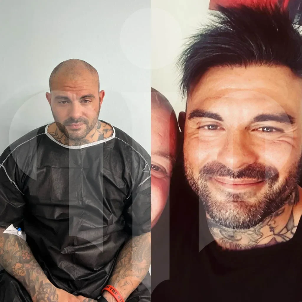 turkey hair center before after 3 1