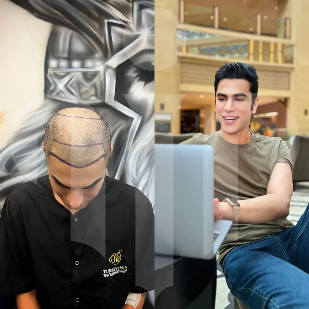 turkey hair center before after 6 1