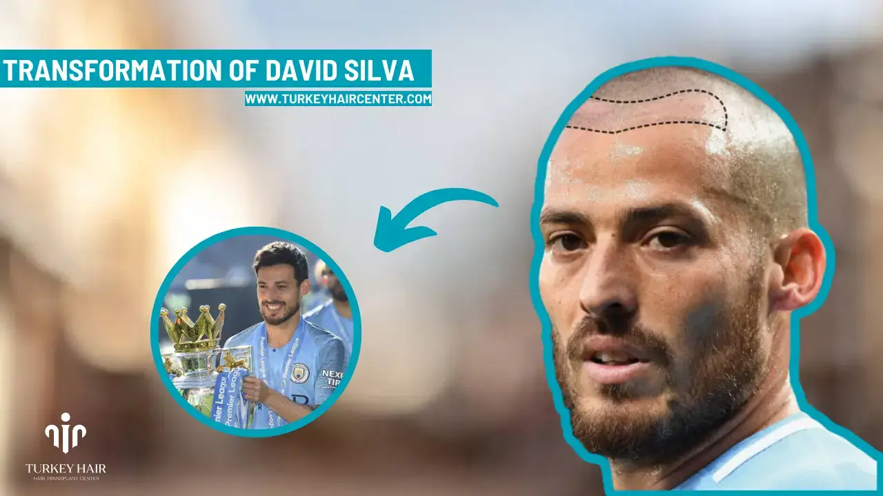 David Silva Hair Transplant