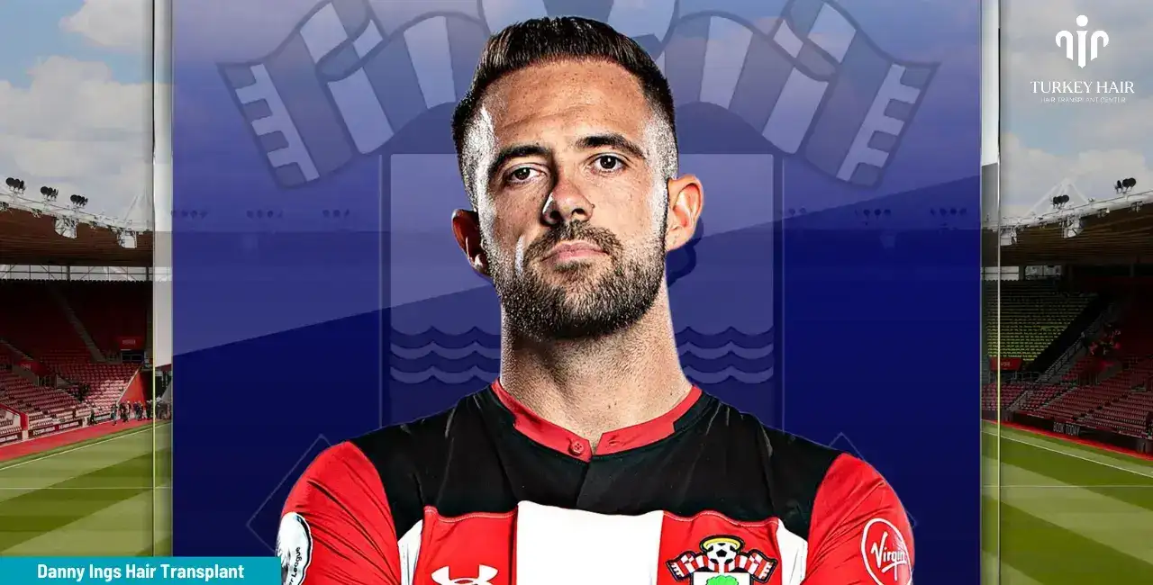 Danny Ings Hair Transplant 8 From Turkey Hair Center On Danny Ings' Hair Transplant