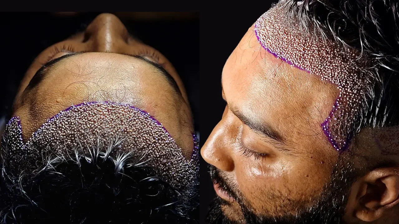 dhi hair transplant