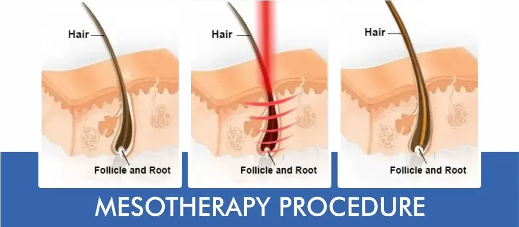 Mesotherapy