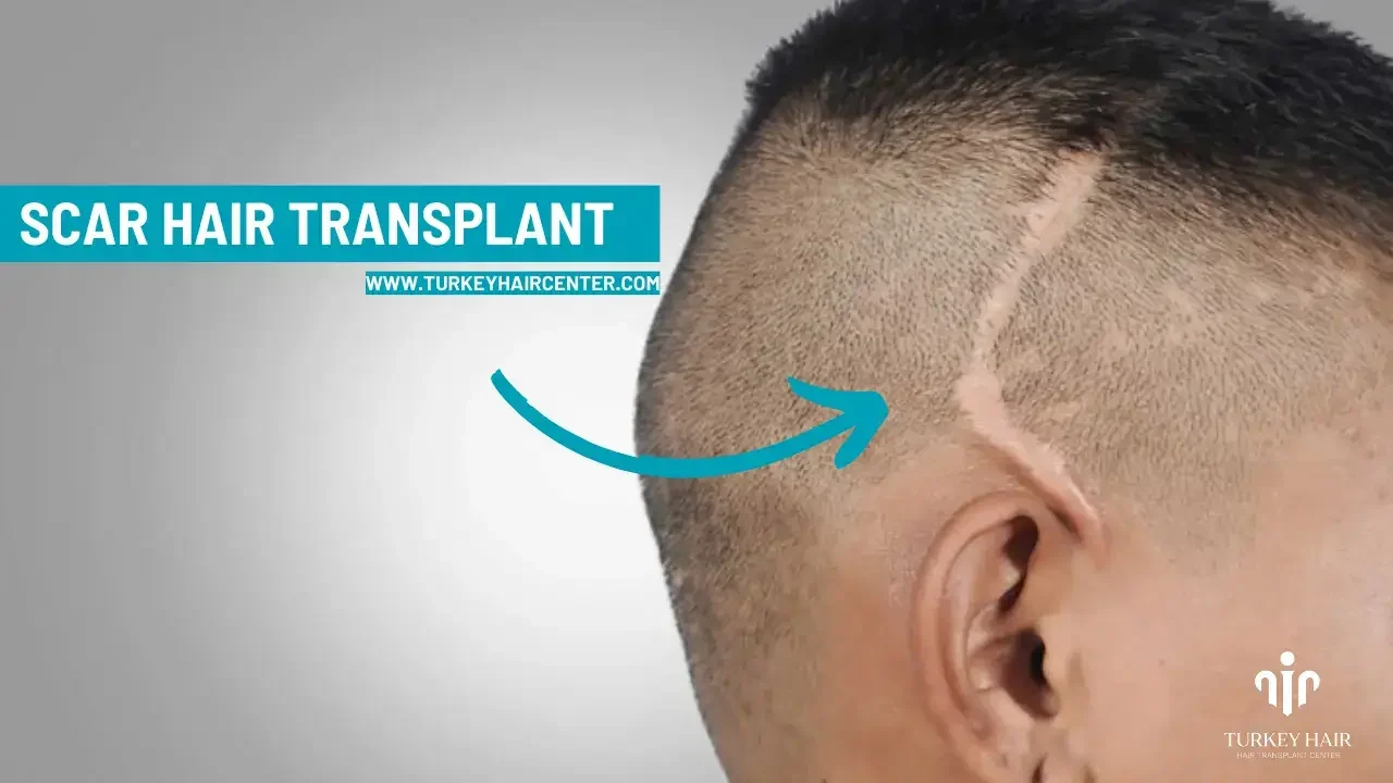 scar hair transplant