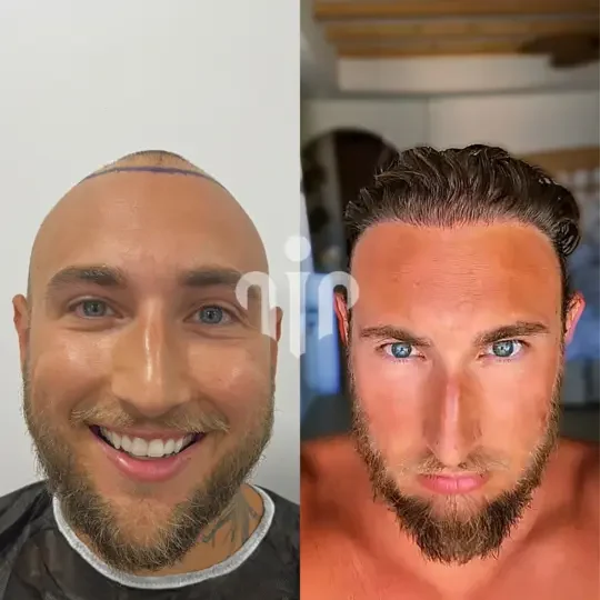 Turkey Hair Transplant Before and After02 1