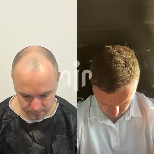 Turkey Hair Transplant Before and After03 2
