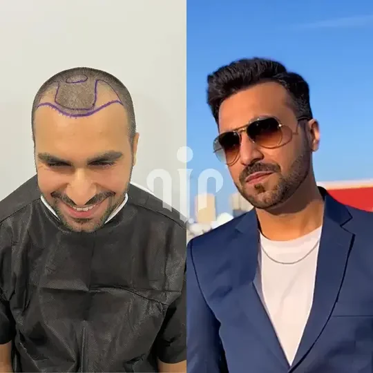 Turkey Hair Transplant Before and After04 2