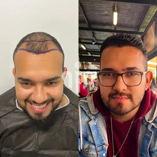 Turkey Hair Transplant Before and After05 2