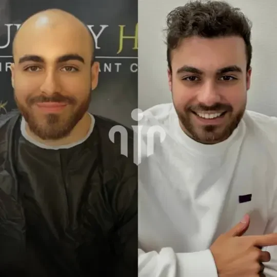 Turkey Hair Transplant Before and After06 1