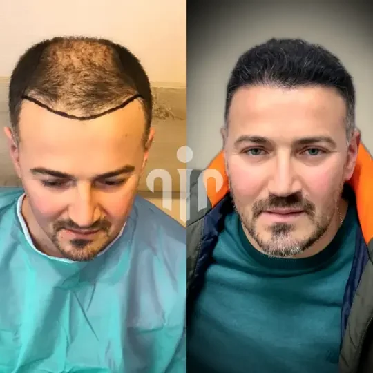 Turkey Hair Transplant Before and After07 2