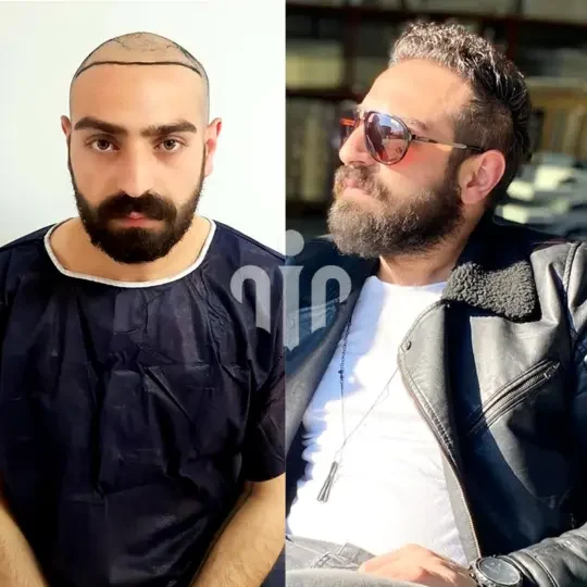Turkey Hair Transplant Before and After08 1