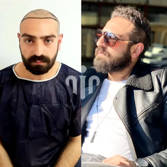 Hair Transplant Before and After | Turkey Hair Center
