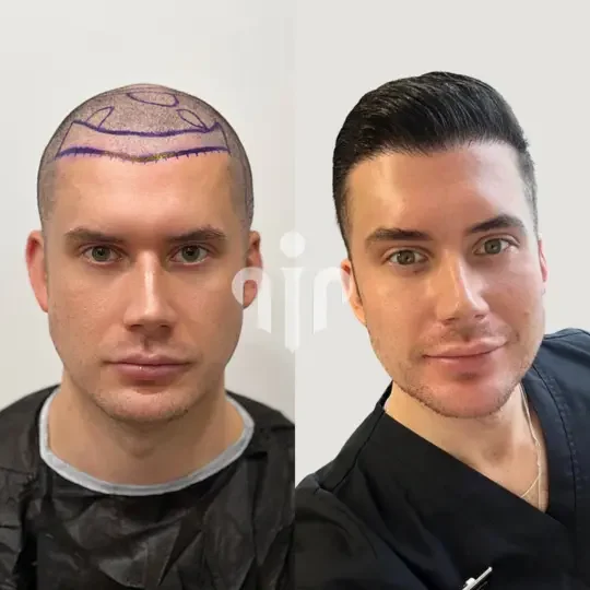 Turkey Hair Transplant Before and After09 1