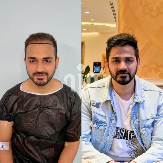 Turkey Hair Transplant Before and After11 1
