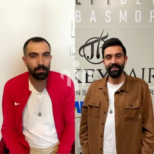 Turkey Hair Transplant Before and After12 1