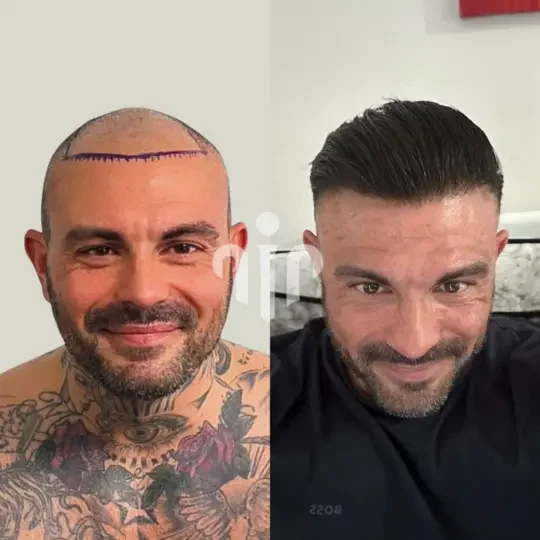 Turkey Hair Transplant Before and After13