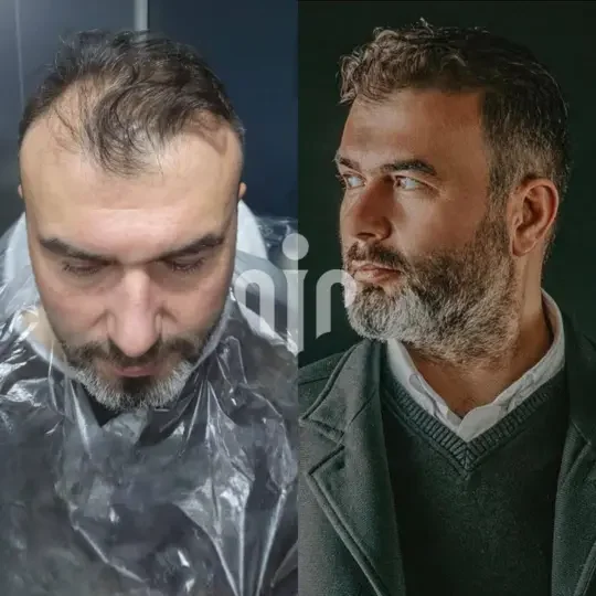 Turkey Hair Transplant Before and After16