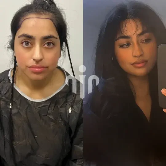 Turkey Hair Transplant Before and After17
