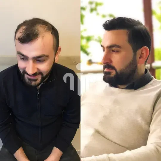 Turkey Hair Transplant Before and After19