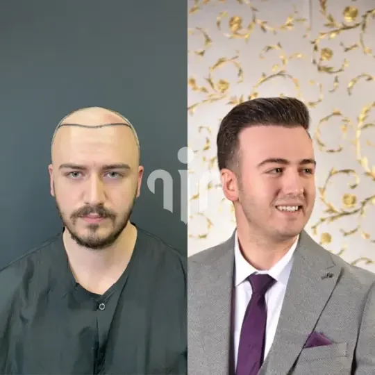 Turkey Hair Transplant Before and After21