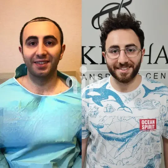 Turkey Hair Transplant Before and After22