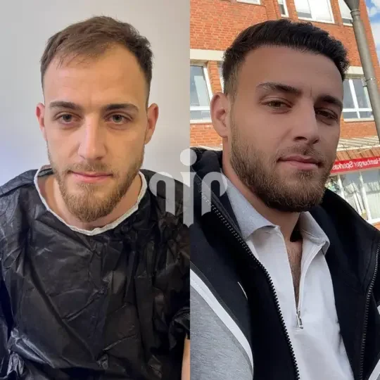 Turkey Hair Transplant Before and After23