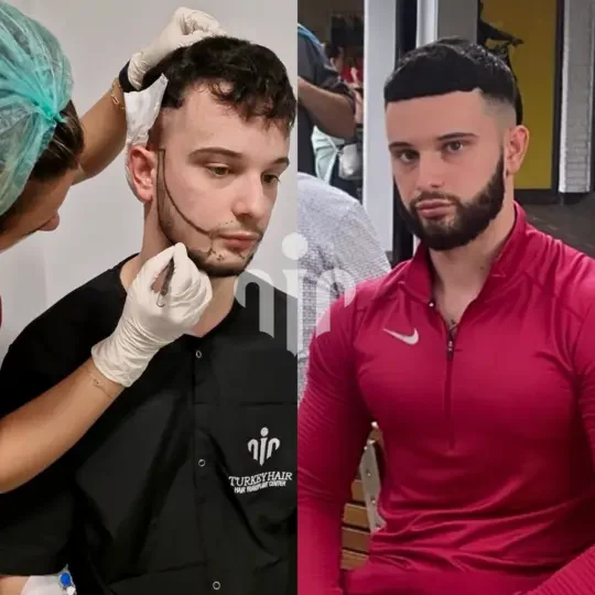 Turkey Hair Transplant Before and After25