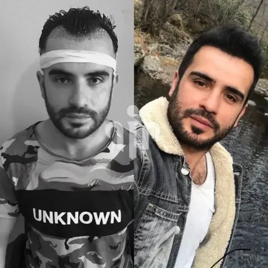Turkey Hair Transplant Before and After26