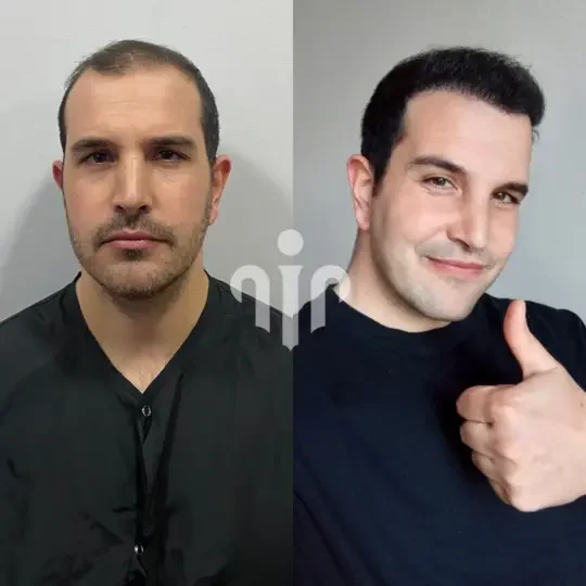 Turkey Hair Transplant Before and After27