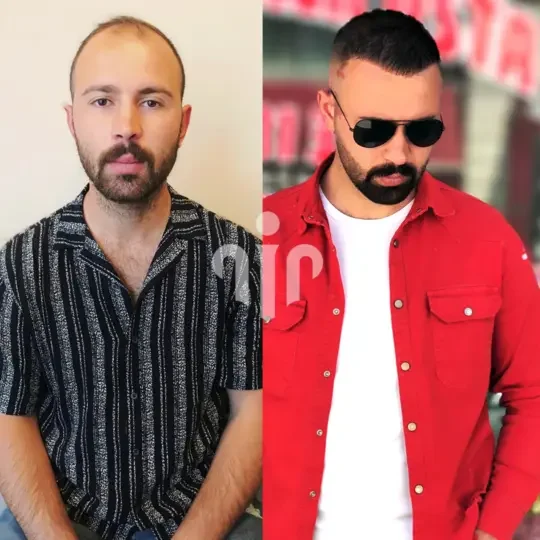 Turkey Hair Transplant Before and After28