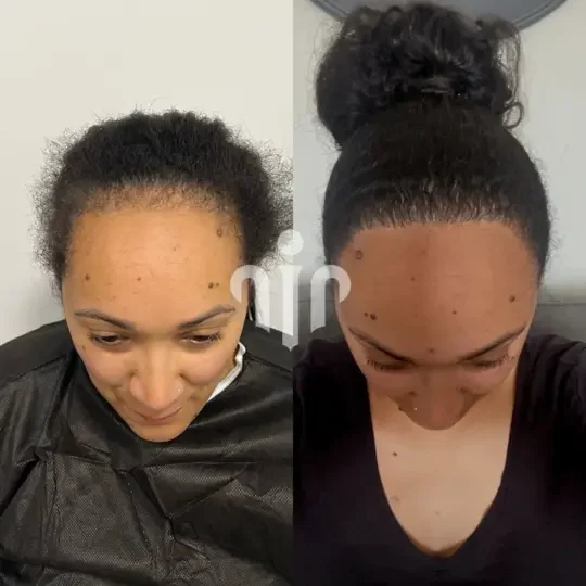 Turkey Hair Transplant Before and After29