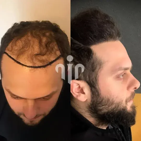 Turkey Hair Transplant Before and After31
