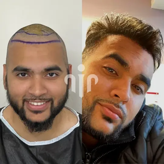 Turkey Hair Transplant Before and After32