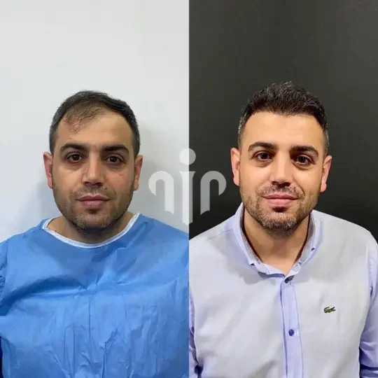 Turkey Hair Transplant Before and After33