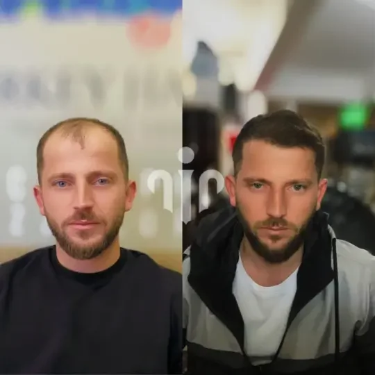 Turkey Hair Transplant Before and After37