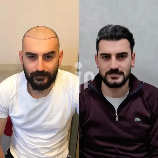 Turkey Hair Transplant Before and After38