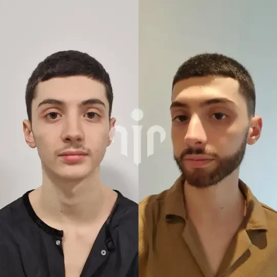 Turkey Hair Transplant Before and After39