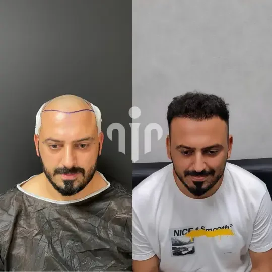 Turkey Hair Transplant Before and After40