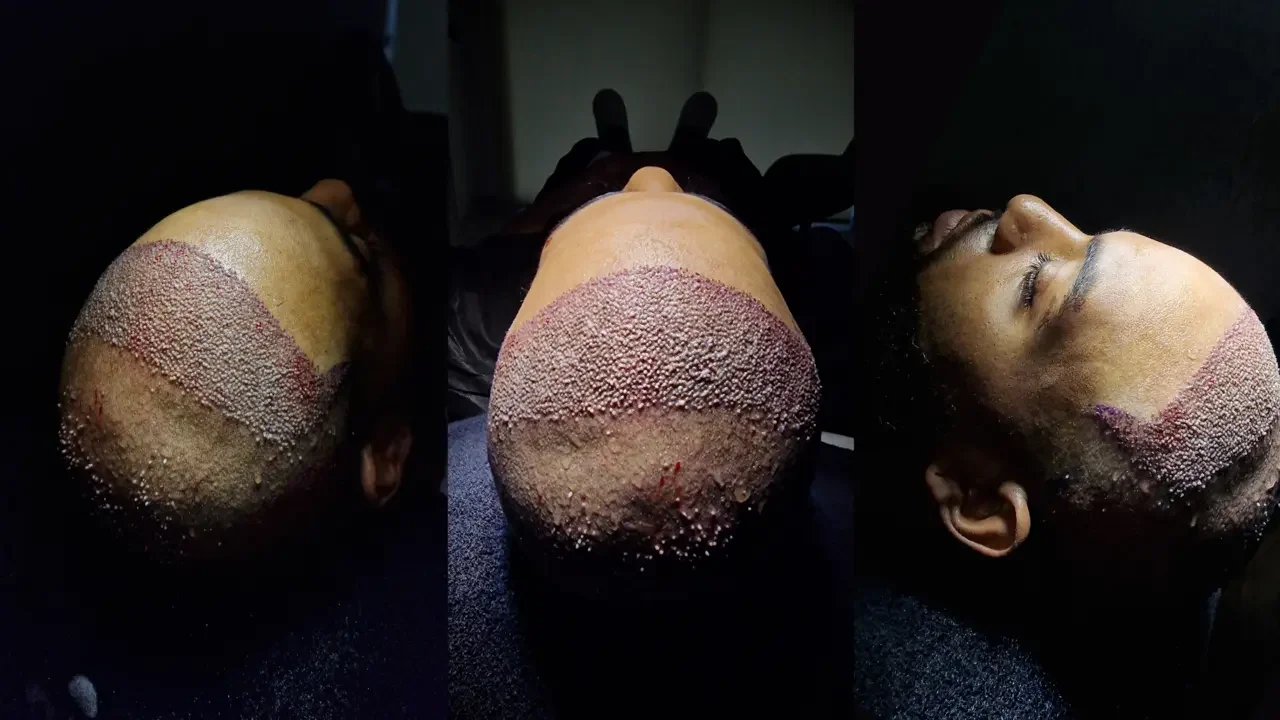 afro hair transplant fue