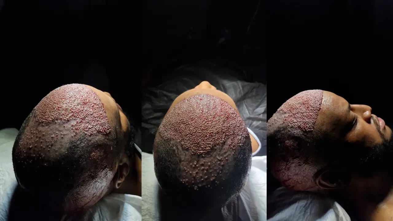 afro hair transplant in turkey istanbul